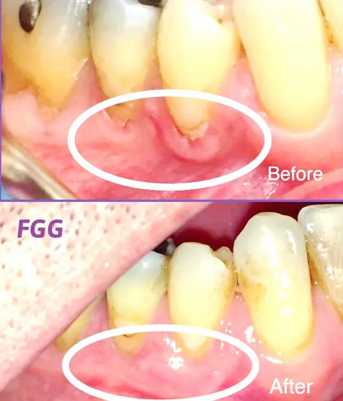 Gum Grafting before and after photos