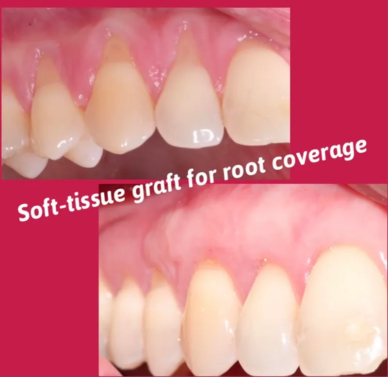 Soft-tissue graft for root coverage before and after photos