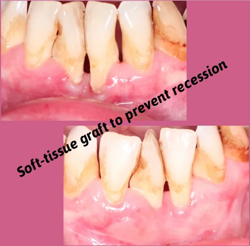 Soft-tissue graft to prevent recession before and after photos